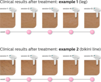 Philips Lumea Advanced IPL SC1997/00 IPL Szőrtelenítő